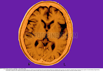 ALZHEIMER MALADIE IRM!ALZHEIMER DISEASE  MRI