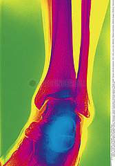 CHEVILLE RADIO!ANKLE  X-RAY