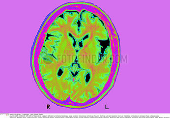 ALZHEIMER MALADIE IRM!ALZHEIMER DISEASE  MRI