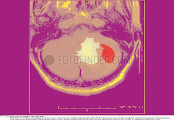 EPILEPSIE RMN!EPILEPSY  MRI