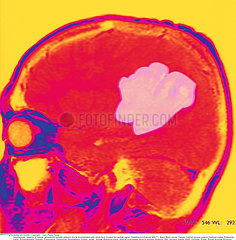 TUMEUR CERVEAU RMN!BRAIN CARDIA  MRI