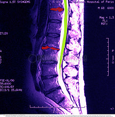 ARTHROSE VERTEBRE IRM!VERTEBRAL ARTHROSIS  MRI