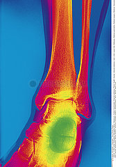CHEVILLE RADIO!ANKLE  X-RAY