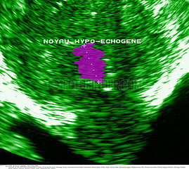 CANCER PROSTATE ECHOGRAPHIE!CANCER OF THE PROSTATE SONOGRAPH
