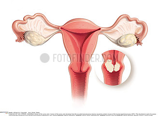 CANCER UTERUS DESSIN!CANCER OF THE UTERUS  DRAWING