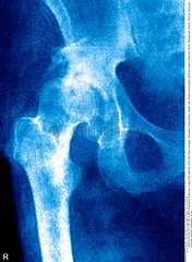 LUXATION HANCHE RADIO!DISLOCATION OF THE HIP  X-RAY
