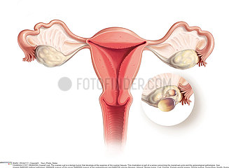 KYSTE OVAIRE DESSIN!OVARIAN CYST  DRAWING
