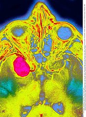 NEURINOME NERF OPTIQUE RMN!OPTIC NERVE SCHWANNOMA  MRI
