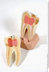 CARIE DENT!TOOTH DECAY