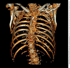 THORAX SCANNER 3D!!THORAX  3D SCAN