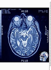 CERVEAU RMN!BRAIN  MRI