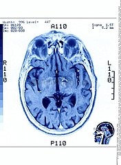 CERVEAU RMN!BRAIN  MRI