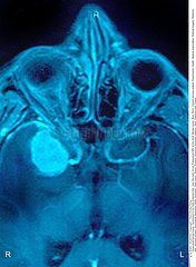 NEURINOME NERF OPTIQUE RMN!OPTIC NERVE SCHWANNOMA  MRI