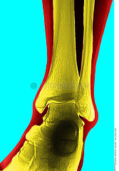 ANKLE  X-RAY