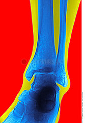 ANKLE  X-RAY