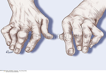 ARTHRITIS HAND DRAWING