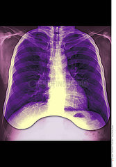 LUNG  X-RAY RESULT