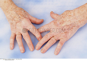 HAND OSTEOARTHRITIS
