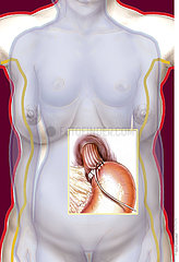 OBESITY GASTRIC BAND