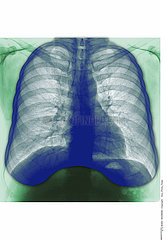 LUNG  X-RAY RESULT