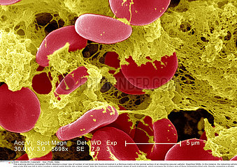 RED BLOOD CELL & FIBRIN  SEM