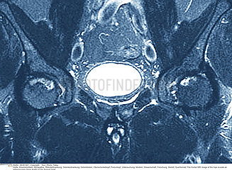 OSTEONECROSIS OF THE HIP