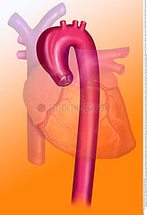 ANEURYSM OF THE AORTIC ARCH