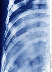 FRACTURED RIB  X-RAY
