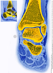 FOOT  MRI