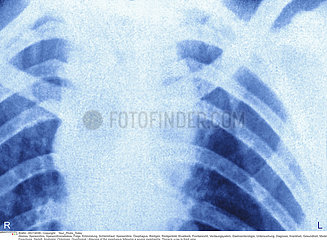 ESOPHAGEAL ABSCESS  X-RAY