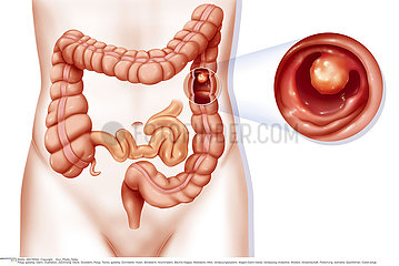 COLON POLYP  DRAWING