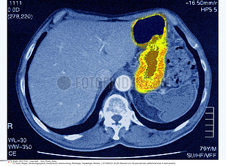STOMACH  SCAN