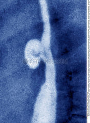 ESOPHAGEAL DIVERTICULUM  X-RAY