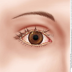 INFECTIOUS CONJUNCTIVITIS  DRAW.