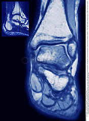 FOOT  MRI