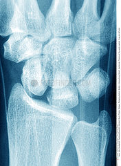FRACTURED WRIST  X-RAY