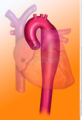 ANEURYSM OF THE THORACIC AORTA