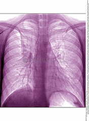 ASTHMA  X-RAY