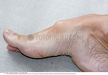 HIGH ARCHED FOOT