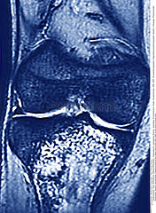 OSTEOSARCOMA  MRI
