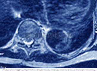 AORTIC DISSECTION  MRI