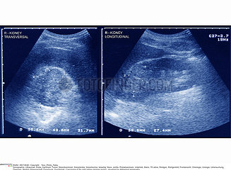 RENAL CARCINOMA  SONOGRAPHY