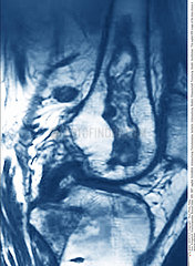 OSTEONECROSIS OF THE KNEE RMN