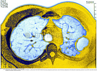 LUNG SCAN FOR EMPHYSEMA