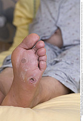 DIABETIC FOOT
