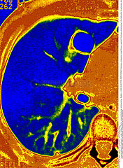 LUNG SCAN FOR EMPHYSEMA