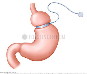 GASTRIC BAND