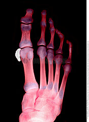 FOOT CALCIFICATION  X-RAY