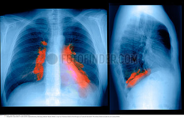 LUNG INFECTION  X-RAY