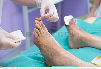 Reportage_184 Endokrinologie / DIABETIC FOOT